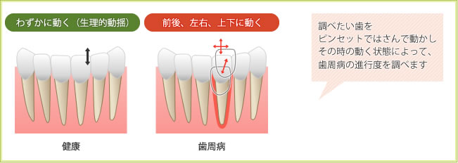 健康＝わずかに動く（生理的動揺）　歯周病＝前後・左右・上下に動く　／調べたい歯をピンセットではさんで動かしその時の
                    動く状態によって、歯周病の進行度を調べます。
