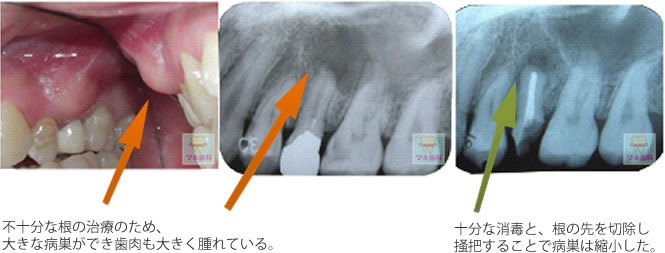 不十分な根の治療のため、大きな病巣ができ歯肉も大きく腫れている。十分な消毒と、根の先を切除し掻把することで病巣は縮小した。