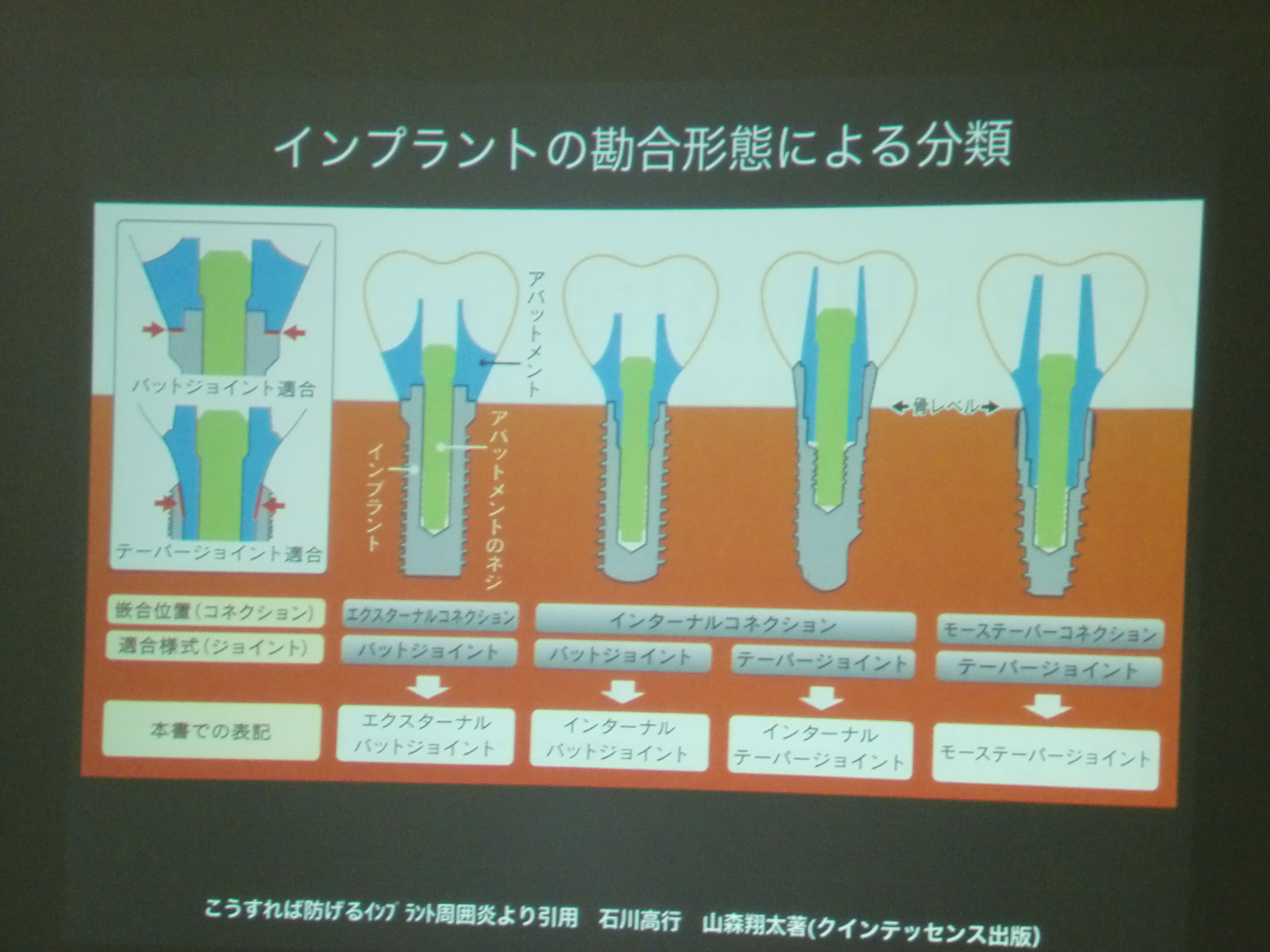 こうすれば防げるインプラント周囲炎